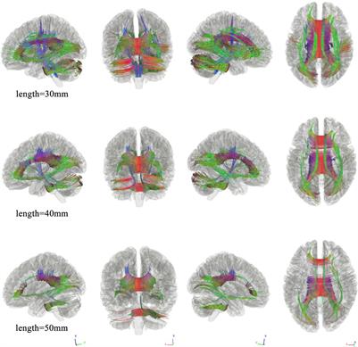 Clinical and cognitive correlates tractography analysis in patients with white matter hyperintensity of vascular origin